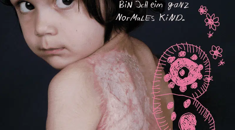 Am 7. Dezember 2020 ist Tag des brandverletzten Kindes. Die Initiative Paulinchen - Initiative für brandverletzte Kinder e. V. möchte an diesem Tag auf die Gefahren durch Verbrennungs- oder Verbrühungsunfälle für Kinder hinweisen.